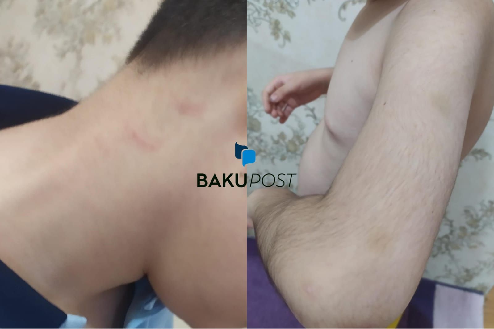 Məktəbdə fiziki zorakılıq: Bu dəfə müəllimin uşağı döyüldü - FOTO+YENİLƏNİB