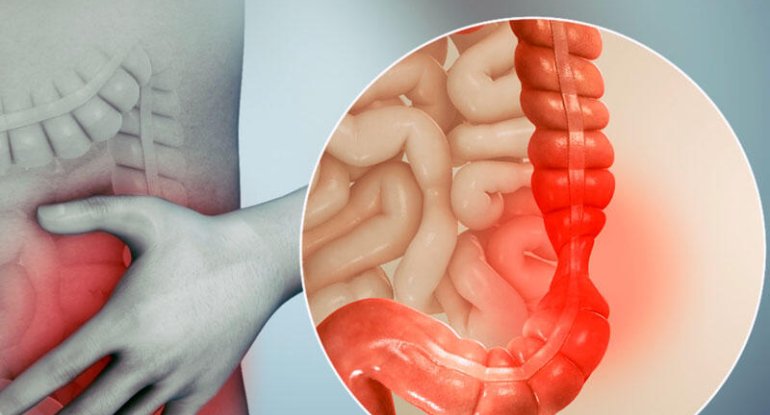Gizli təhlükə: Bu simptom bağırsaq xərçənginin əsas xəbərçisidir