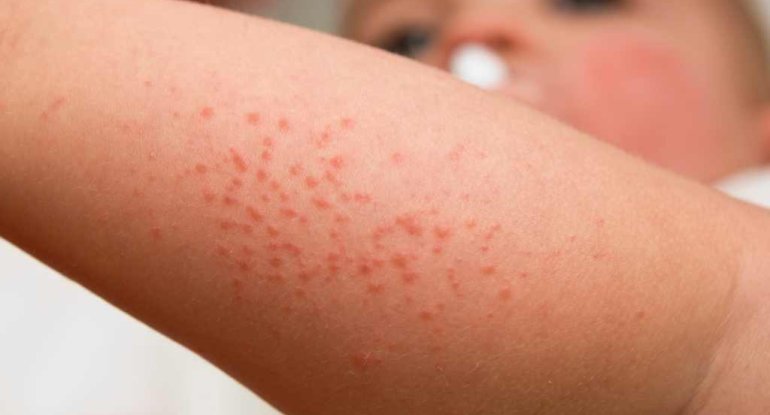 Uşaqlar arasında yayılan bu xəstəlik ürəyi və böyrəyi zədələyə bilər - XƏBƏRDARLIQ